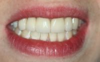 All Porcelain Bridge After Photo Bayside pics