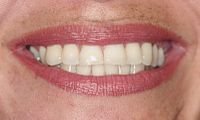 veneer bite repair