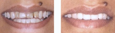 New Teeth Porcelain Crowns Bayside Queens