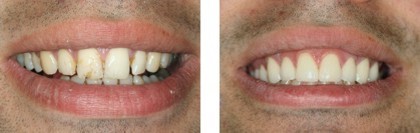 Veneer Makeover Treatment Bayside Queens