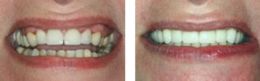 Fix Repair Replace Bad Worn Crowns Bayside Queens