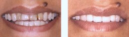 New Teeth Porcelain Crowns Bayside Queens