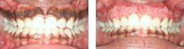 Dark Gums  Pink Gums Bayside Queens Pictures