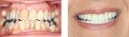 Instant Braces Teeth Straightening No Ugly Braces Bayside NY