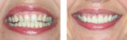 Instant Orthodontics Bayside NY Queens New York