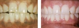 Dark Gum Laser Pink Gums Bayside Queens