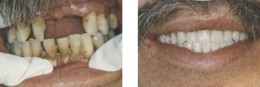 Bayside New One Day Teeth
