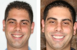 Veneer Makeover Dentistry Smile  Bayside NY